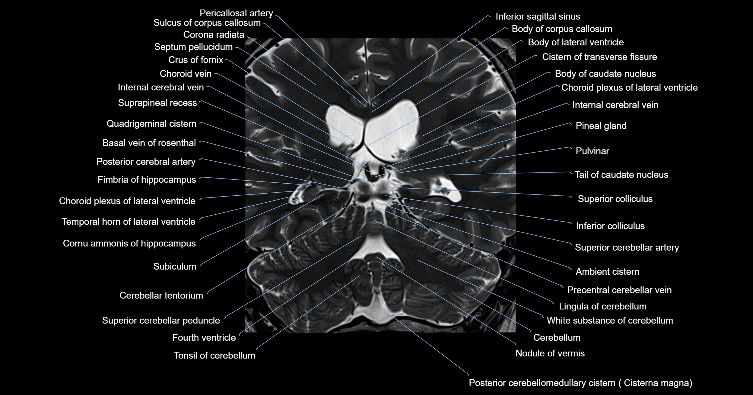 MRI brainstem & basal ganglia anatomy labelled 3T MRI images -img-00001-00031.webp